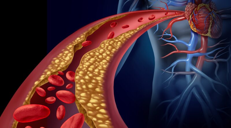 Desarrollan una inmunoterapia para limpiar las arterias en pacientes sin respuesta a fármacos contra el colesterol